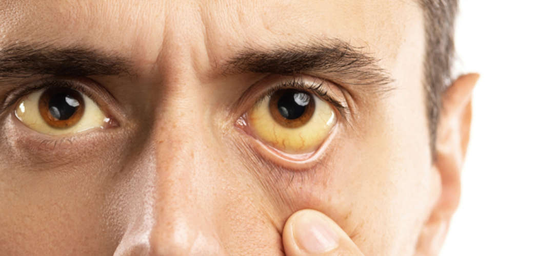 jaundice-cases-latestinfo-precuations