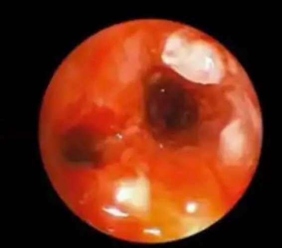 A piece of chicken bone in the lung of a 62-year-old man