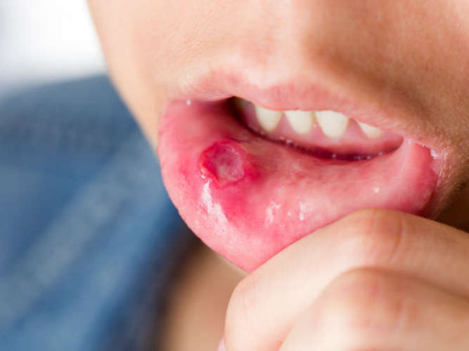 ulcers-and-sores-your-mouth-may-be-trying-to-warn-you-about-lurking-internal-diseases