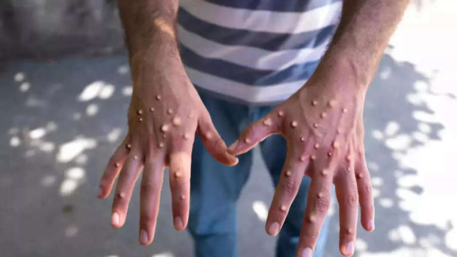 Health Ministry Confirms No MPox Cases in the Country