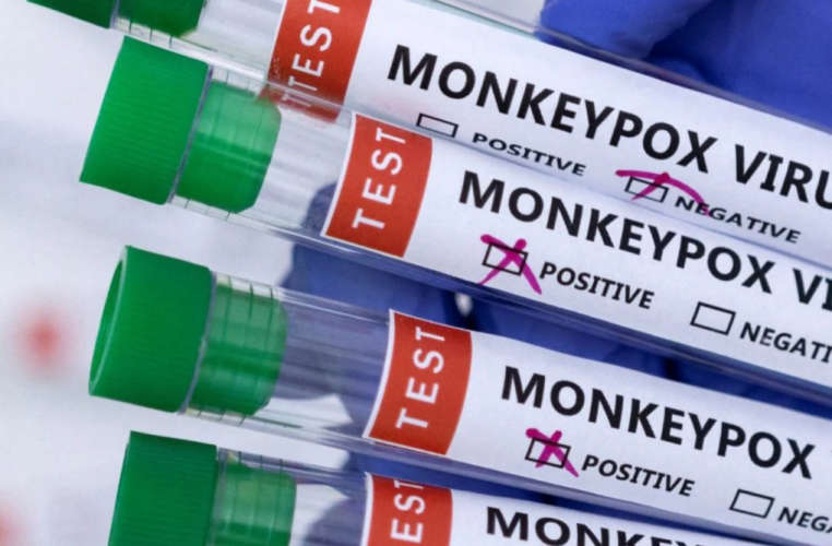Suspected Monkeypox Case in Kannur Person with Symptoms Hospitalized After Returning from Abroad