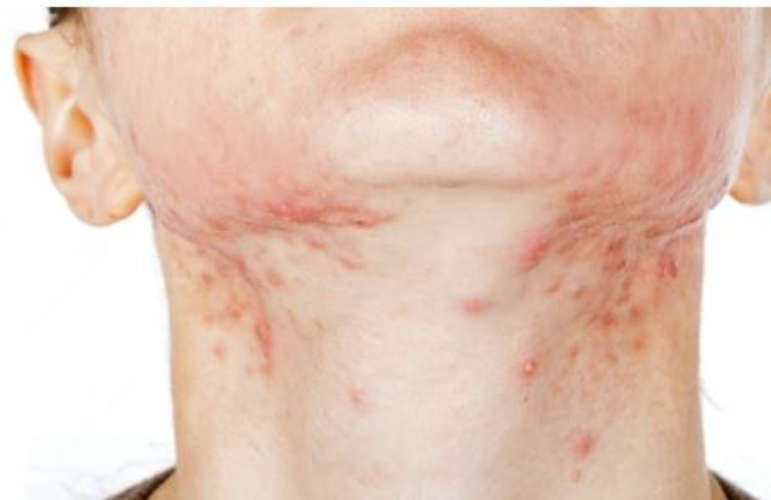 Do you have pimples on your neck This could be the reason