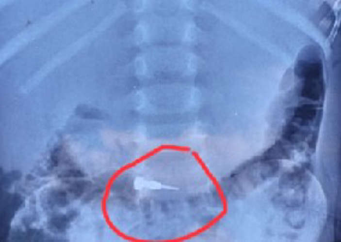 Part of the appliance lodged in the four-year-olds stomach during dental treatment