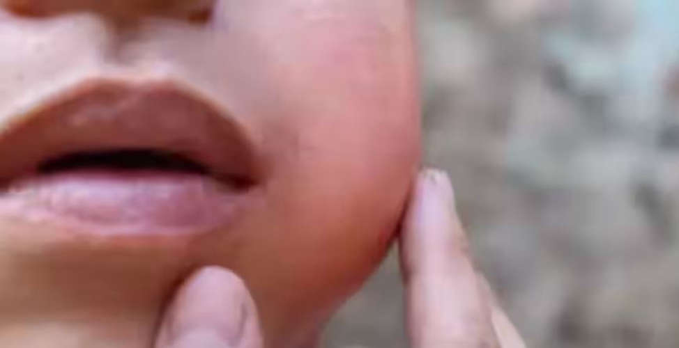 Five children of Perumbalam LPS School have mumps 21 days off from today