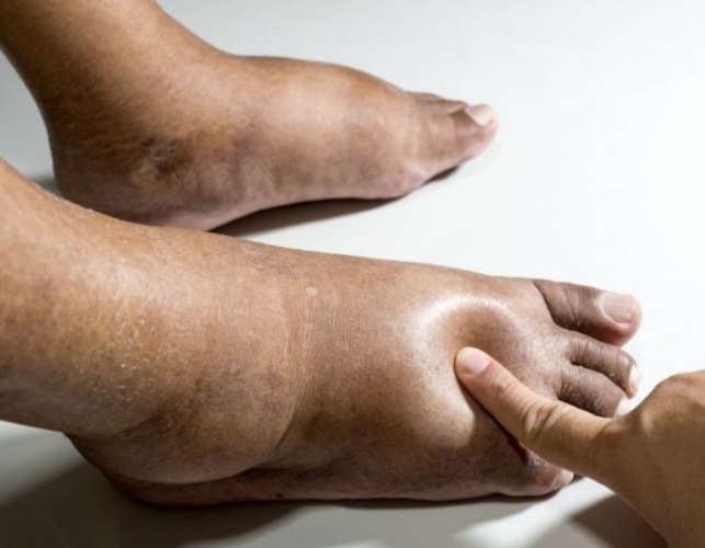 Swollen feet Be careful - this can be a symptom of diseases