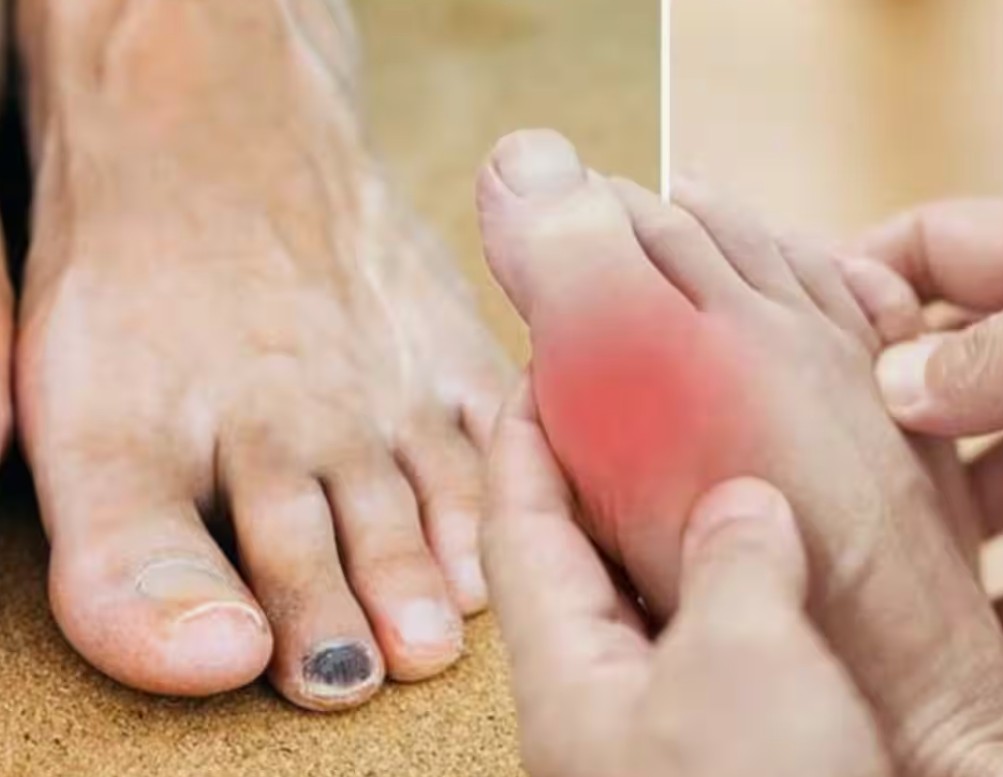 High Cholesterol The Silent Killer  Know the Warning Signs in Your Feet