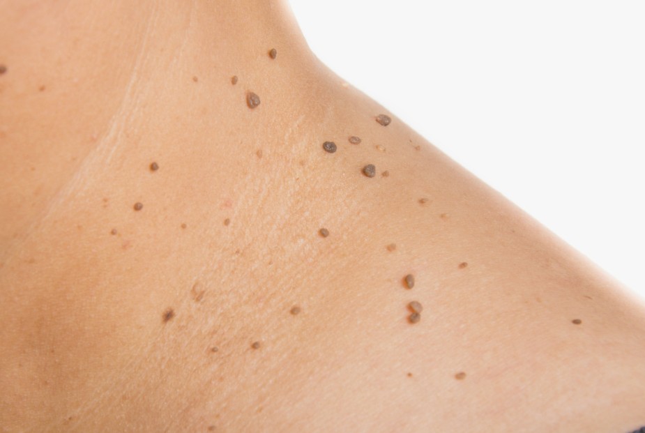 What Causes Skin Tags Arimpara and How to Remove Them Naturally