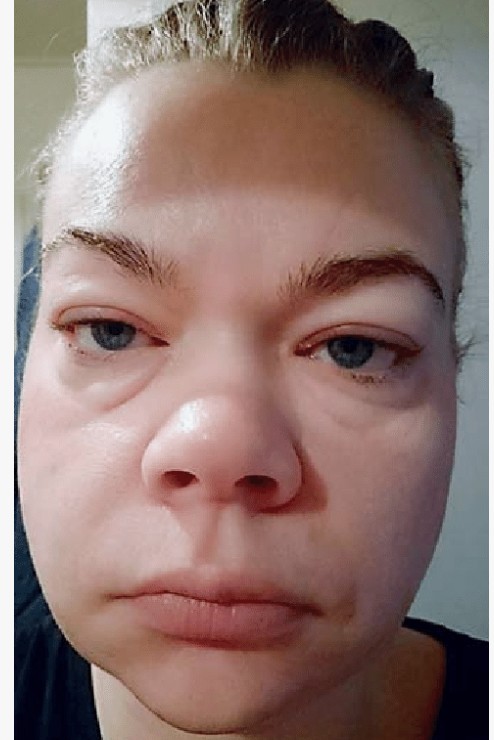 Why Does Your Face Swell After Sleeping in AC or Cooler