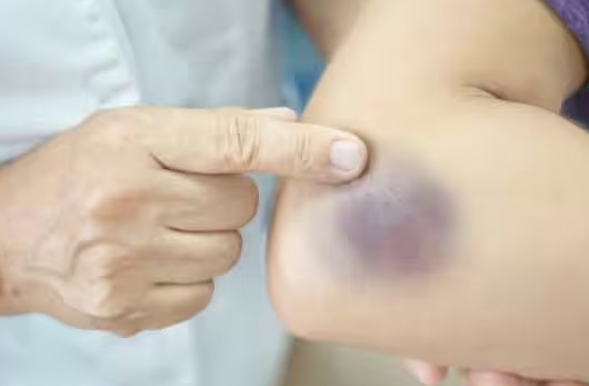 How and Why Blood Clots Under the Skin Natural Home Remedies