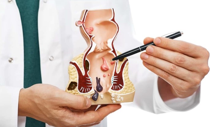 Anal Cancer Symptoms Causes and Early Diagnosis Can Save Lives