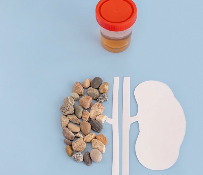 Foods to Avoid If You Have Kidney Stones