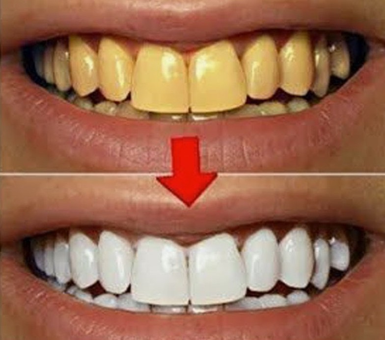  Simple Home Remedies to Whiten Yellow Teeth Naturally