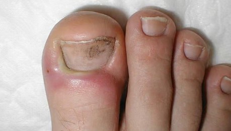 prevent-paronychia-new tricks-latest updation