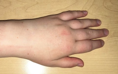 swollen fingers common causes and how to manage them